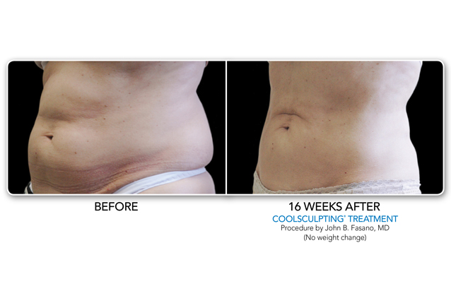 Losing fat in trouble zones | Before and After Coolsculpting Treatment | Make You Well Family Practice & Aesthetics in Colleyville, TX