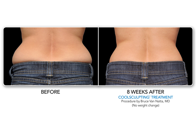 Lose stubborn Fat Love Handles | Before and After Coolsculpting Treatment | Make You Well Family Practice & Aesthetics in Colleyville, TX