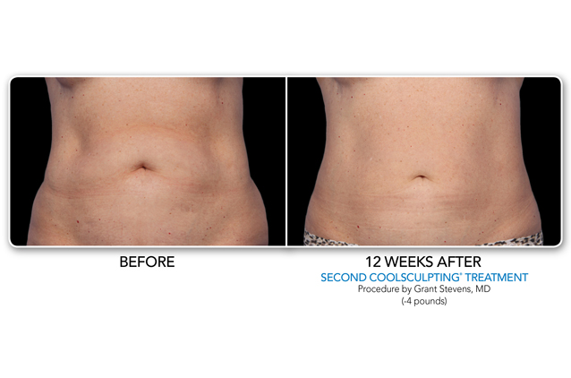 Before and After Coolsculpting Treatment | Make You Well Family Practice & Aesthetics in Colleyville, TX