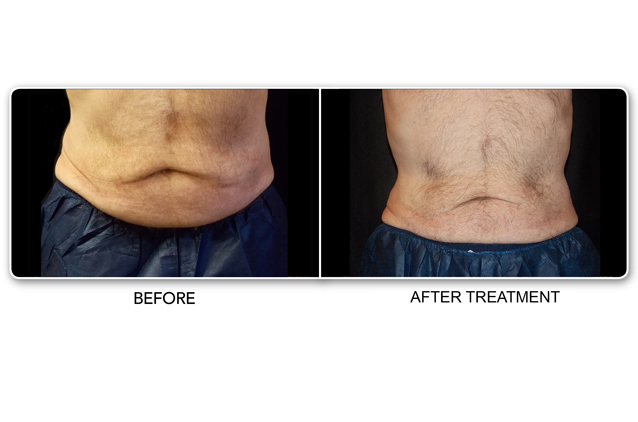 Fat Reduction Stomach | Before and After fat reduction Treatment | Make You Well Family Practice & Aesthetics in Colleyville, TX