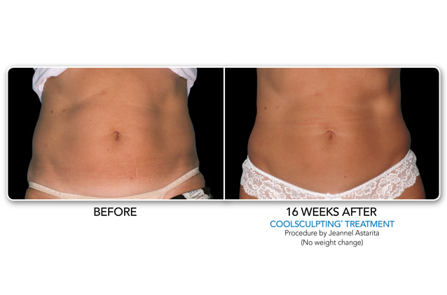 Before and After Coolsculpting Treatment | Make You Well Family Practice & Aesthetics in Colleyville, TX
