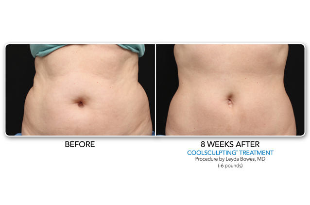 Tone Stomach | Before and After Coolsculpting Treatment | Make You Well Family Practice & Aesthetics in Colleyville, TX