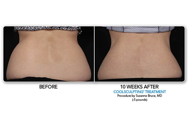 Losing lower back fat | Before and After Coolsculpting Treatment | Make You Well Family Practice & Aesthetics in Colleyville, TX
