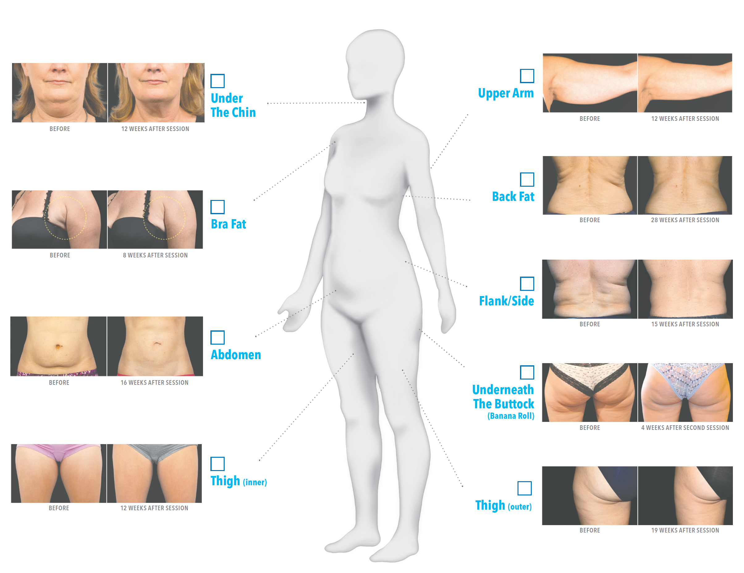 CoolSculpting Treatment Areas-Women